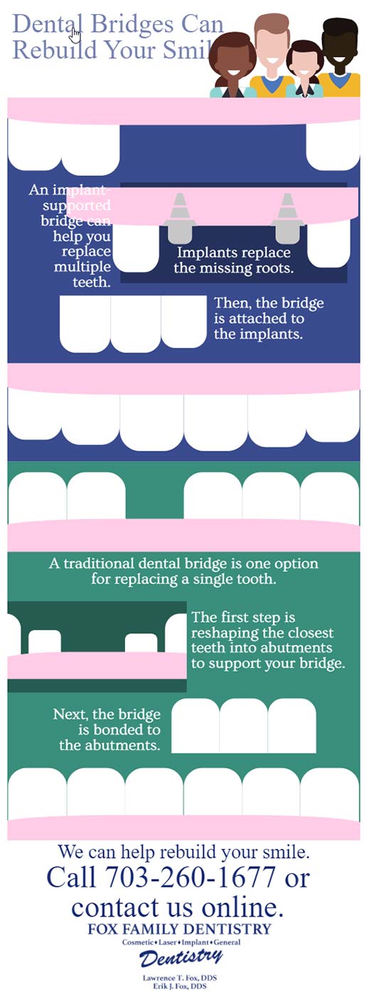 Dental bridges infographic