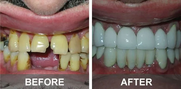 dental work before and after