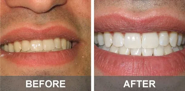 dental work before and after