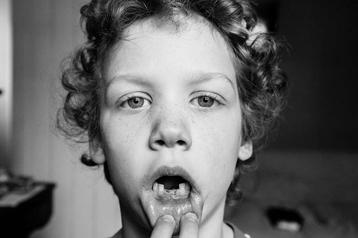 Small kid showing his broken teeth