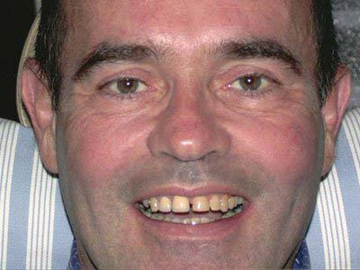 Man's teeth before Cosmetic Dentistry