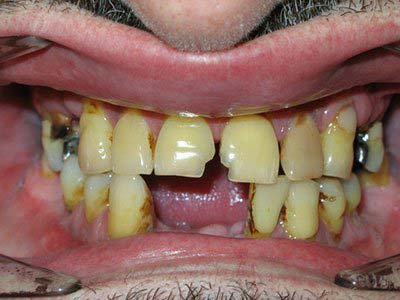 Teeth of a man